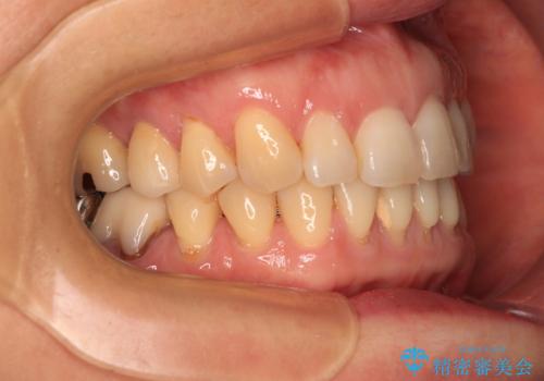 正中のズレと飛び出した前歯を改善 メタルブラケットでの抜歯矯正の治療後