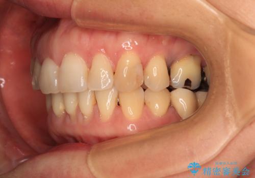 正中のズレと飛び出した前歯を改善 メタルブラケットでの抜歯矯正の治療後