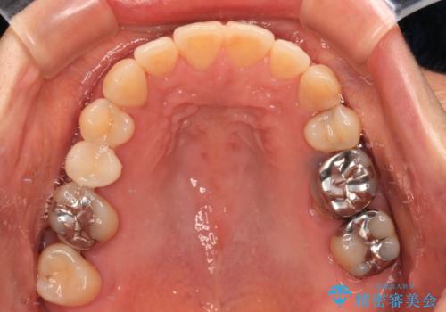 正中のズレと飛び出した前歯を改善 メタルブラケットでの抜歯矯正の治療後