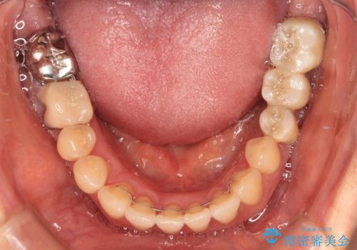 正中のズレと飛び出した前歯を改善 メタルブラケットでの抜歯矯正の治療後
