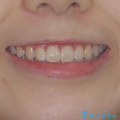 前歯のデコボコを整える インビザラインによる矯正治療の治療後(顔貌)