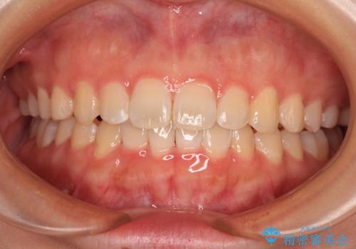 前歯のデコボコを整える　インビザラインによる矯正治療の症例 治療後