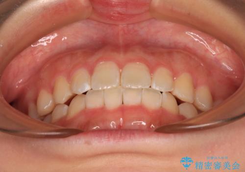 前歯のデコボコを整える インビザラインによる矯正治療の治療後