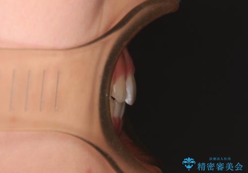 前歯のデコボコを整える インビザラインによる矯正治療の治療後