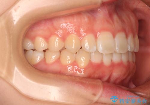 前歯のデコボコを整える インビザラインによる矯正治療の治療後