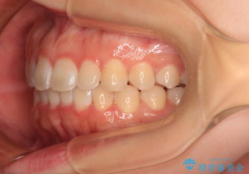 前歯のデコボコを整える　インビザラインによる矯正治療の治療後
