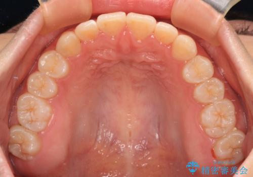 前歯のデコボコを整える インビザラインによる矯正治療の治療後