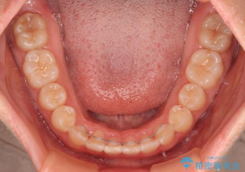 前歯のデコボコを整える インビザラインによる矯正治療の治療後