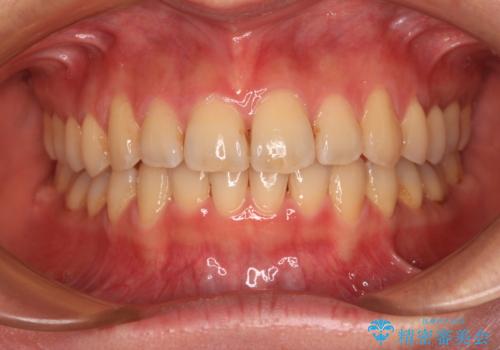 手間をかけずに治したい 短期間のワイヤー矯正の症例 治療後