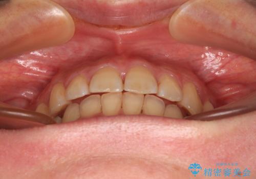 手間をかけずに治したい 短期間のワイヤー矯正の治療後