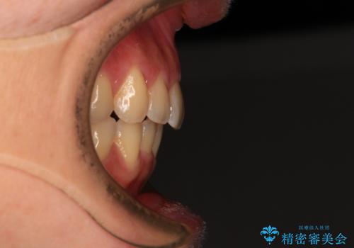 手間をかけずに治したい 短期間のワイヤー矯正の治療後