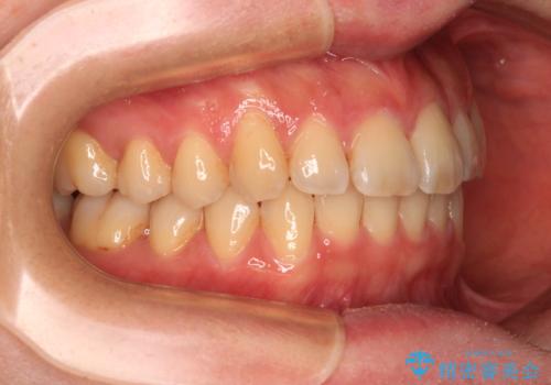 手間をかけずに治したい 短期間のワイヤー矯正の治療後