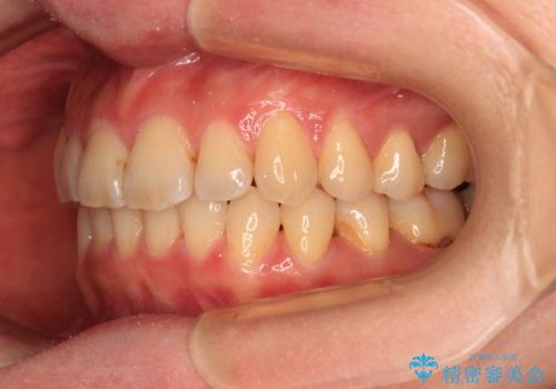 手間をかけずに治したい 短期間のワイヤー矯正の治療後
