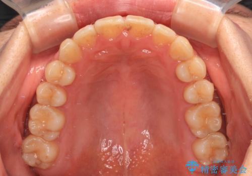 手間をかけずに治したい 短期間のワイヤー矯正の治療後