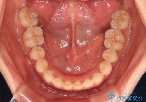 手間をかけずに治したい 短期間のワイヤー矯正の治療後
