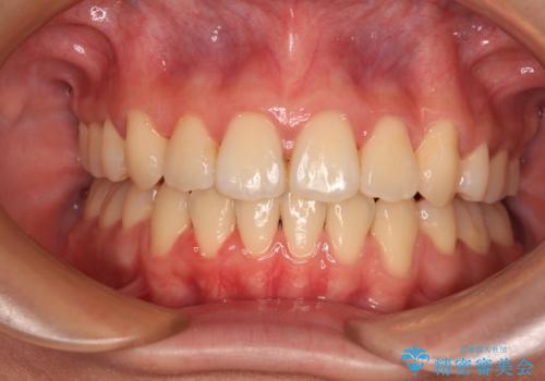 【モニター】舌のトレーニングを行いながら後戻りの再矯正の症例 治療後