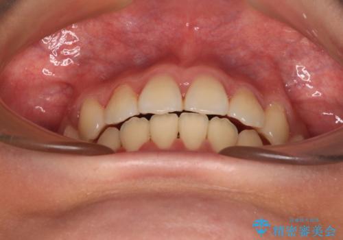 【モニター】舌のトレーニングを行いながら後戻りの再矯正の治療後