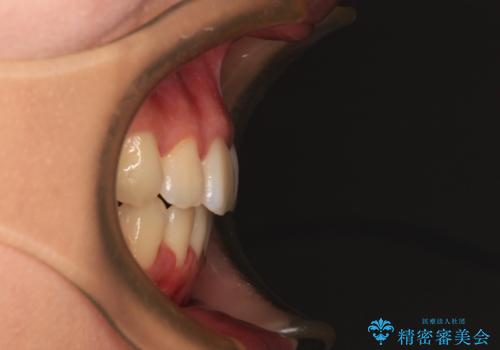 【モニター】舌のトレーニングを行いながら後戻りの再矯正の治療後