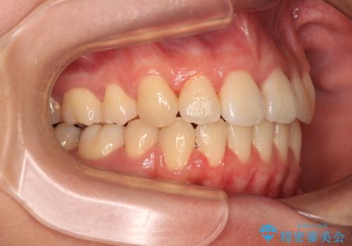 【モニター】舌のトレーニングを行いながら後戻りの再矯正の治療後