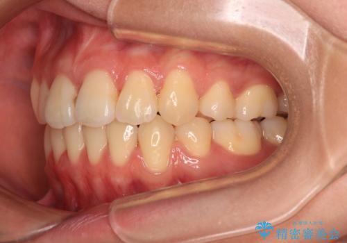 【モニター】舌のトレーニングを行いながら後戻りの再矯正の治療後