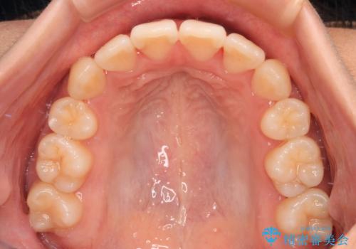 【モニター】舌のトレーニングを行いながら後戻りの再矯正の治療後
