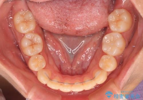 【モニター】舌のトレーニングを行いながら後戻りの再矯正の治療後
