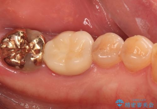 欠けてしまった奥歯のむし歯治療の治療後
