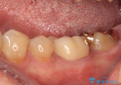 欠けてしまった奥歯のむし歯治療の治療後