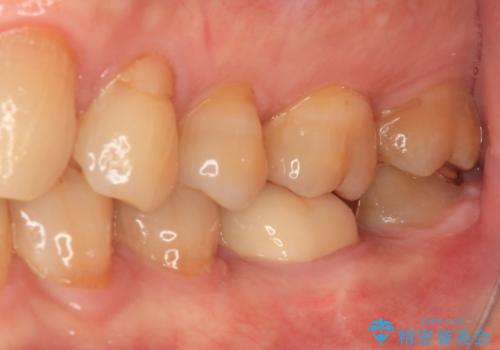 欠けてしまった奥歯のむし歯治療の治療後