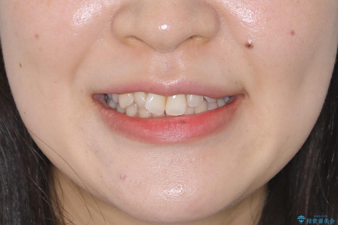 【非抜歯】下の前歯が1本少ない場合の矯正治療の治療前（顔貌）
