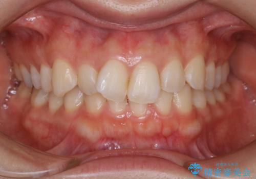 【非抜歯】下の前歯が1本少ない場合の矯正治療の症例 治療前