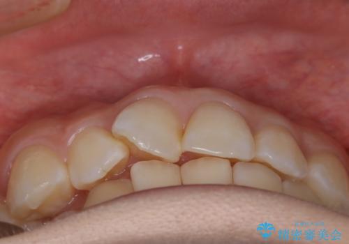 【非抜歯】下の前歯が1本少ない場合の矯正治療の治療前
