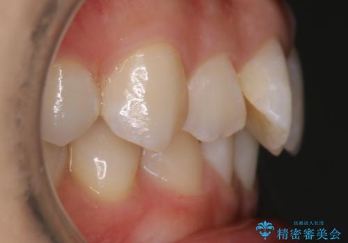 【非抜歯】下の前歯が1本少ない場合の矯正治療の治療前