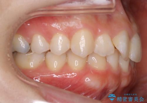 【非抜歯】下の前歯が1本少ない場合の矯正治療の治療前