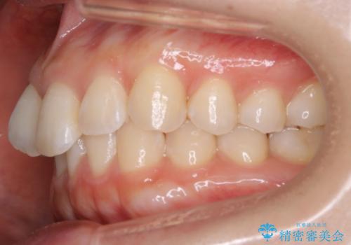 【非抜歯】下の前歯が1本少ない場合の矯正治療の治療前