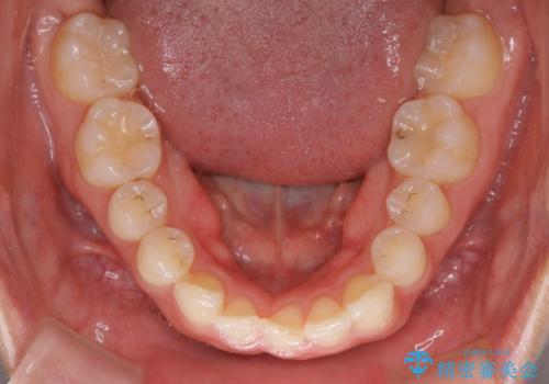 【非抜歯】下の前歯が1本少ない場合の矯正治療の治療前