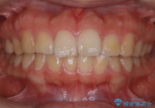 【非抜歯】ガタつきと歯軸を正して長持ちする歯への症例 治療前