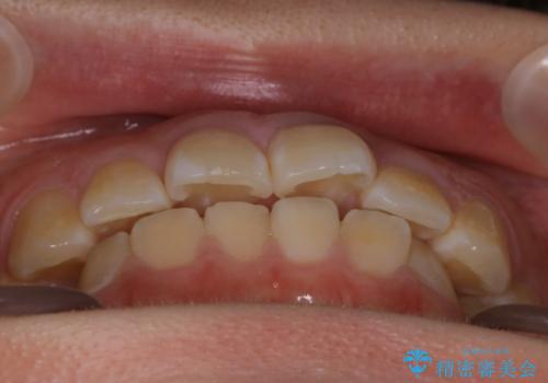 【非抜歯】ガタつきと歯軸を正して長持ちする歯への治療前