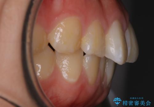 【非抜歯】ガタつきと歯軸を正して長持ちする歯への治療前