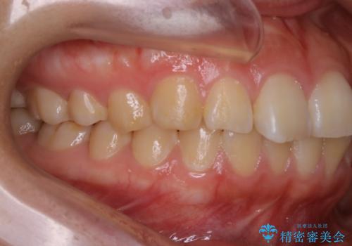 【非抜歯】ガタつきと歯軸を正して長持ちする歯への治療前