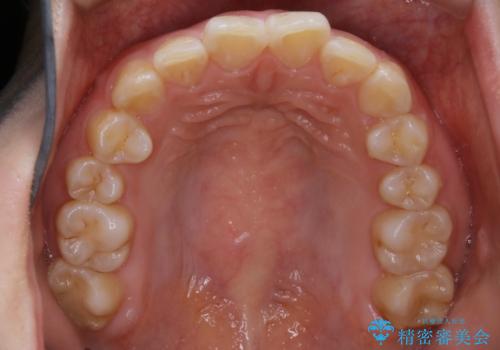【非抜歯】ガタつきと歯軸を正して長持ちする歯への治療前