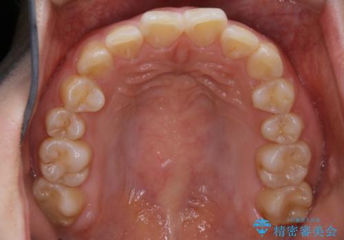 【非抜歯】ガタつきと歯軸を正して長持ちする歯への治療前