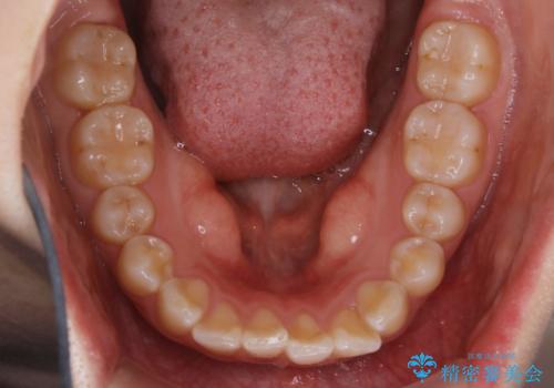 【非抜歯】ガタつきと歯軸を正して長持ちする歯への治療前