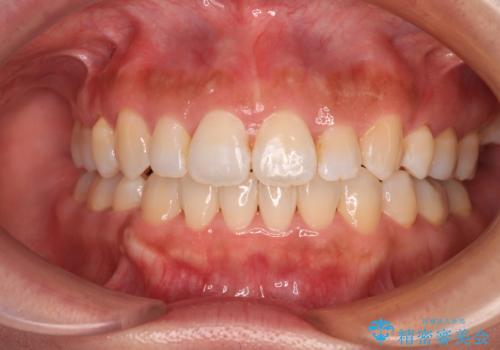 既に2本が抜歯されている歯列　咬み合わせのズレを改善する抜歯矯正の症例 治療後