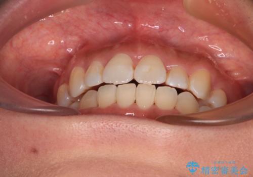 既に2本が抜歯されている歯列 咬み合わせのズレを改善する抜歯矯正の治療後