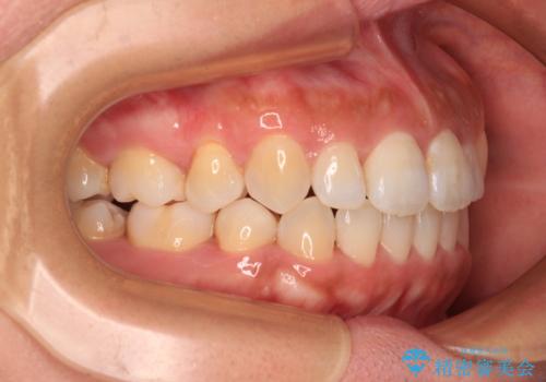 既に2本が抜歯されている歯列 咬み合わせのズレを改善する抜歯矯正の治療後