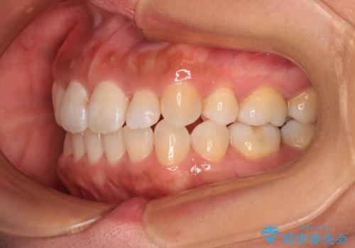 既に2本が抜歯されている歯列　咬み合わせのズレを改善する抜歯矯正の治療後