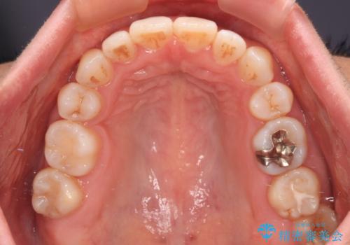 既に2本が抜歯されている歯列 咬み合わせのズレを改善する抜歯矯正の治療後