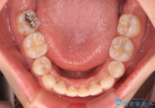 既に2本が抜歯されている歯列　咬み合わせのズレを改善する抜歯矯正の治療後