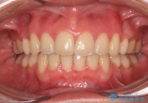 【モニター】横顔のシルエットをスッキリと ワイヤー装置による抜歯矯正治療の症例 治療後